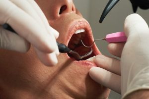 Dental fillings