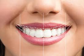Smile Makeover blog