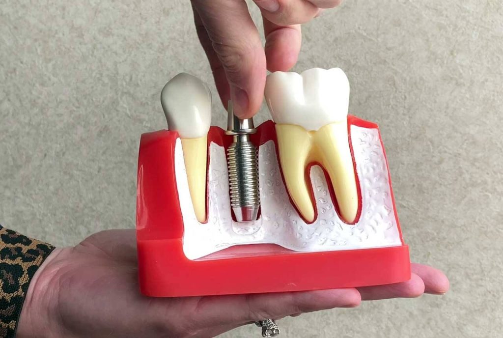 Model showing a dental implant between natural teeth