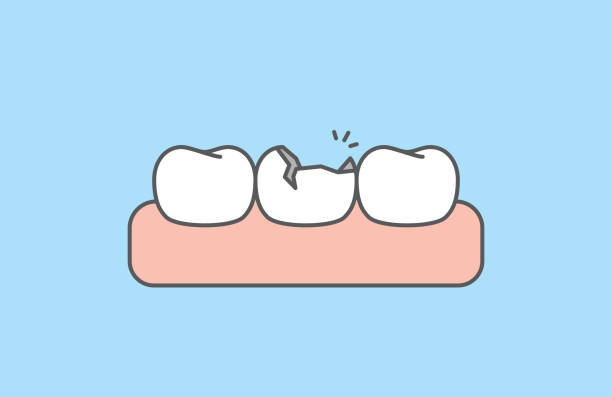 cracked tooth blog